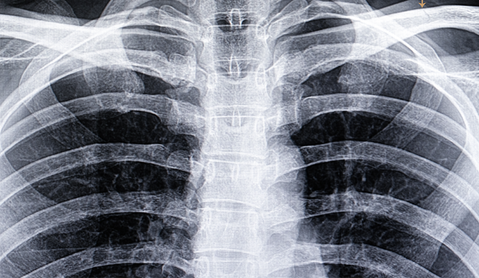 Artificial intelligence can help radiologists diagnose lung diseases