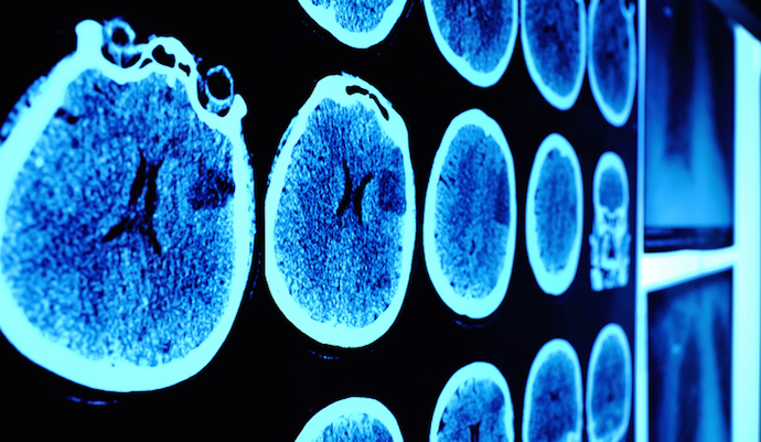 Deep learning can detect COVID-19 in chest CT scans