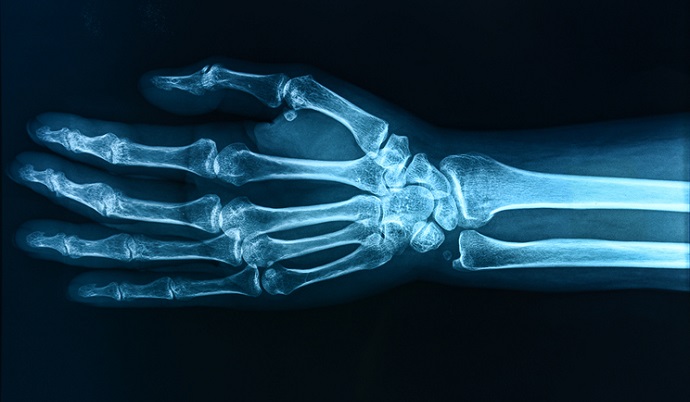 an x-ray of a hand