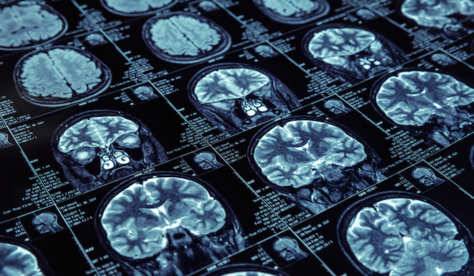 New imaging analytics method may boost schizophrenia treatment