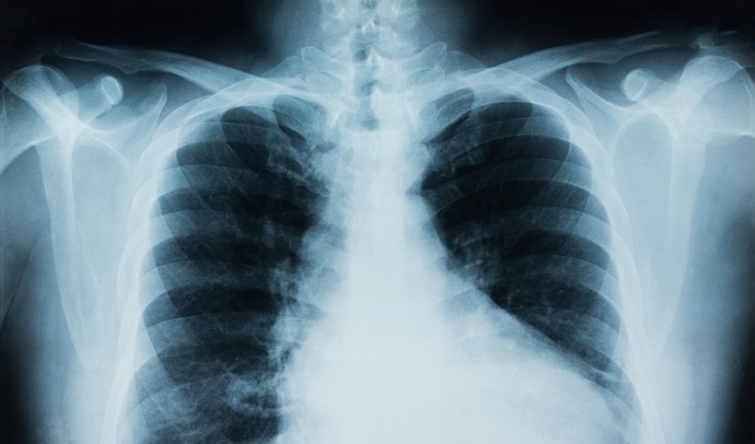 Machine learning tool accurately detects COVID-19 on x-rays